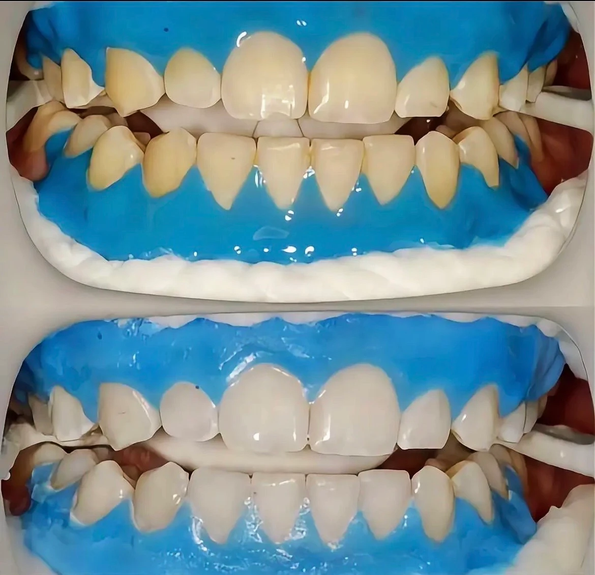 Teeth whitening
