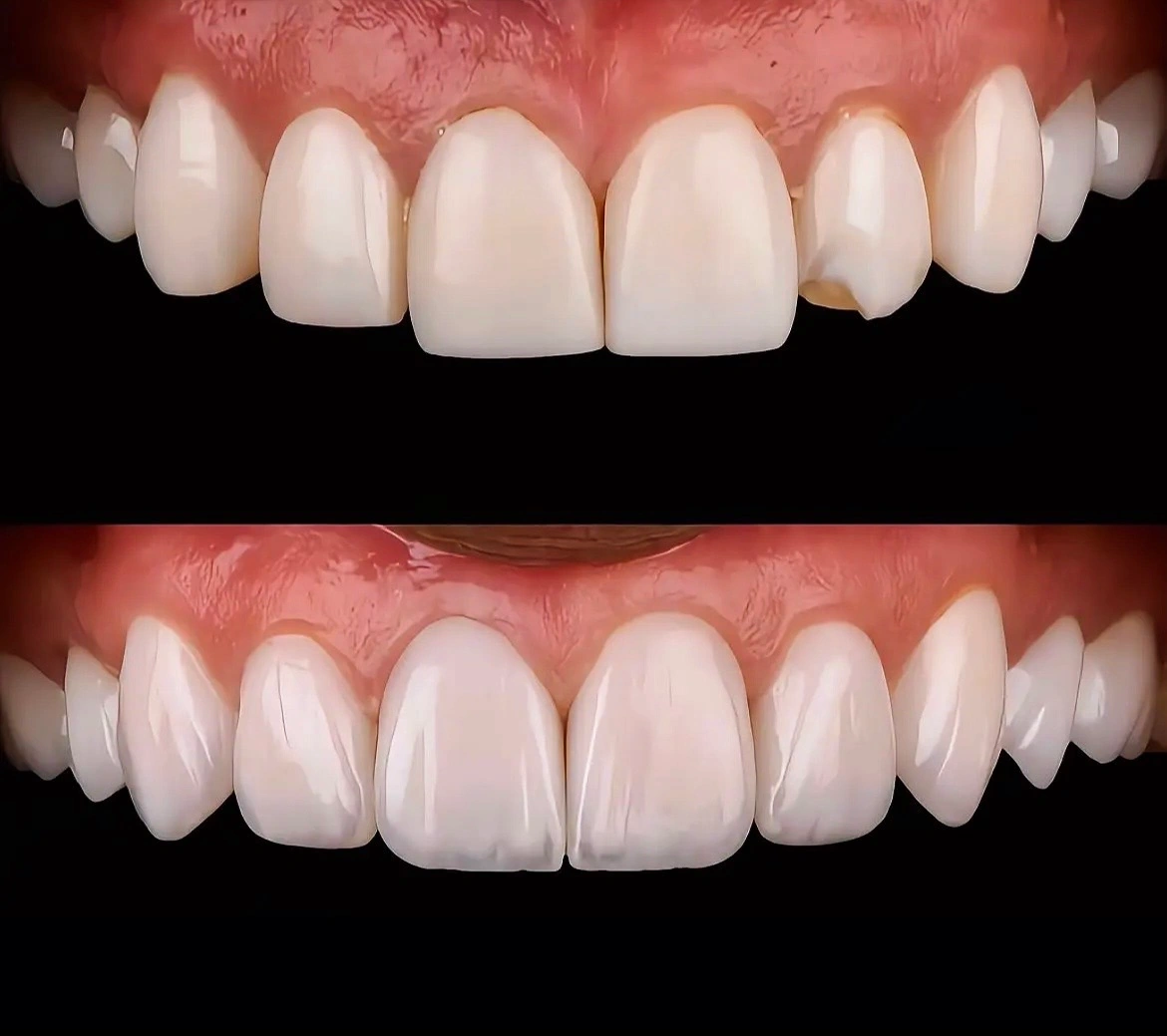 Smile Makeover
