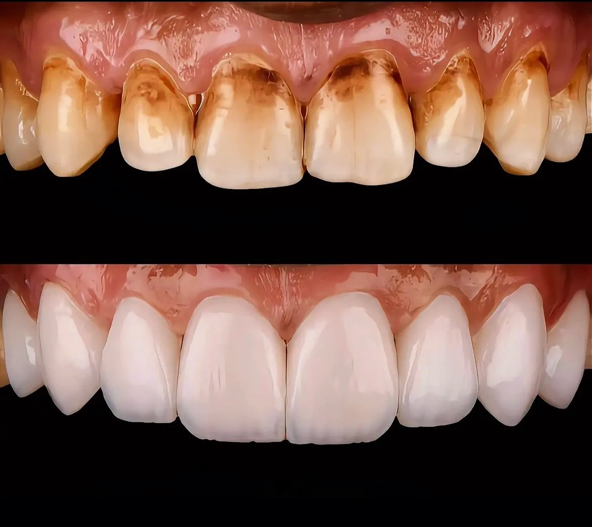 Cosmetic veneers